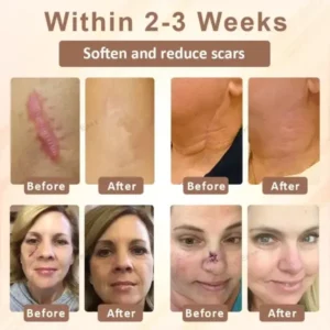 SiliconeFoam Healing Pads