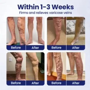 VeinFreedom Herbal Spray – MicroMist Therapy