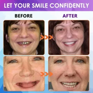 Advanced Customized Full Denture Set