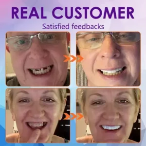Advanced Customized Full Denture Set
