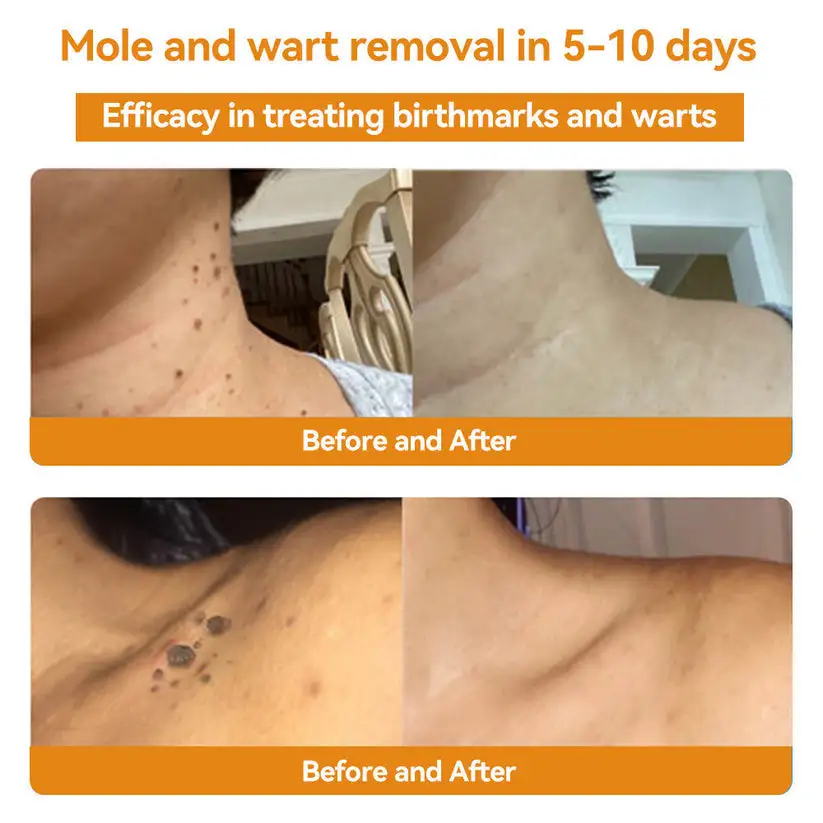Bee Venom Wart & Moles Removal Cream - Image 4