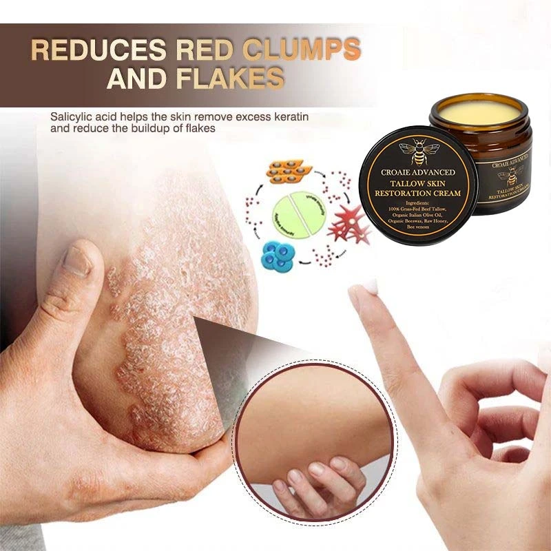 CROAIE 𝐏𝐬𝐨𝐫𝐢𝐚𝐬𝐢𝐬 & 𝐄𝐜𝐳𝐞𝐦𝐚 𝐑𝐞𝐥𝐢𝐞𝐟 𝐂𝐫𝐞𝐚𝐦 - Image 10