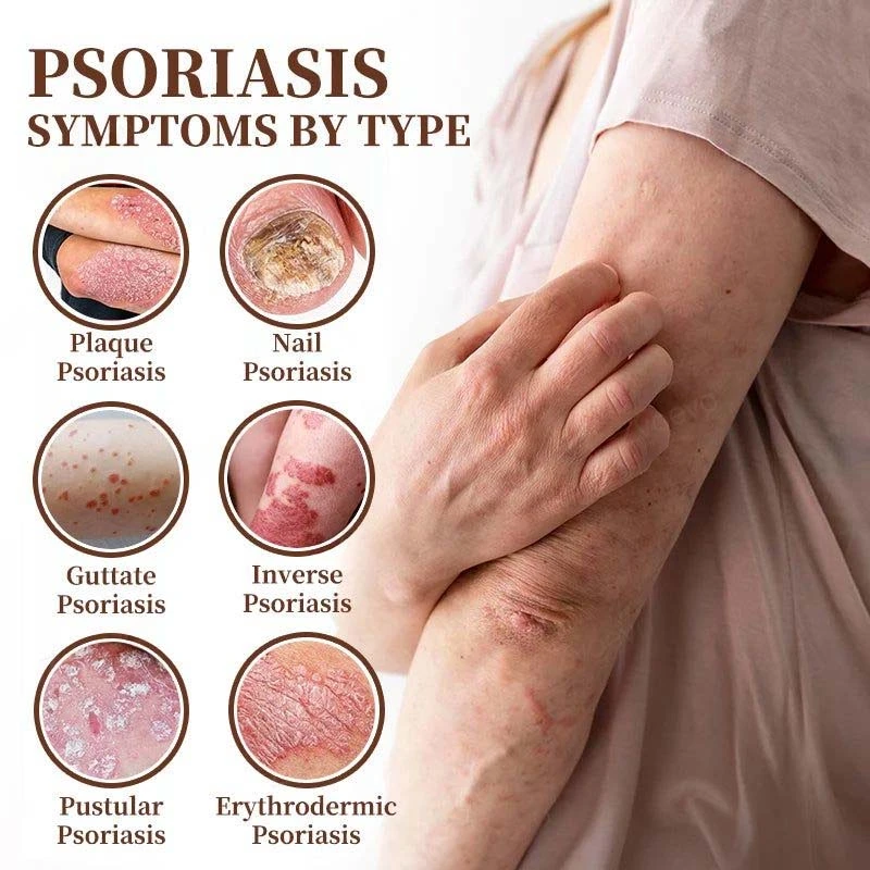 CROAIE 𝐏𝐬𝐨𝐫𝐢𝐚𝐬𝐢𝐬 & 𝐄𝐜𝐳𝐞𝐦𝐚 𝐑𝐞𝐥𝐢𝐞𝐟 𝐂𝐫𝐞𝐚𝐦 - Image 11