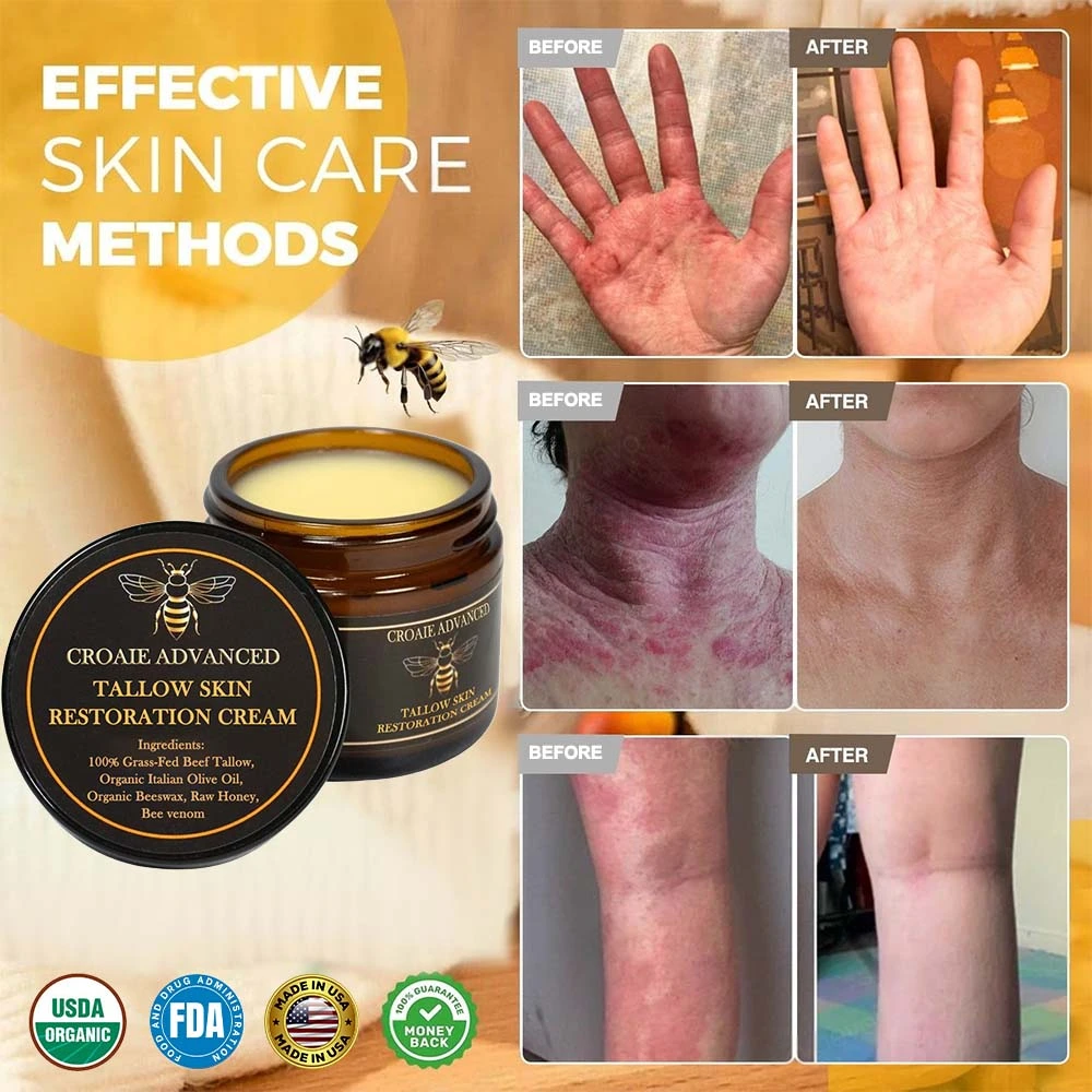 CROAIE 𝐏𝐬𝐨𝐫𝐢𝐚𝐬𝐢𝐬 & 𝐄𝐜𝐳𝐞𝐦𝐚 𝐑𝐞𝐥𝐢𝐞𝐟 𝐂𝐫𝐞𝐚𝐦 - Image 2