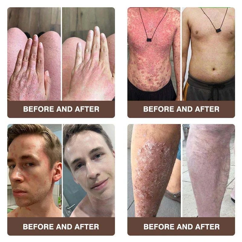 CROAIE 𝐏𝐬𝐨𝐫𝐢𝐚𝐬𝐢𝐬 & 𝐄𝐜𝐳𝐞𝐦𝐚 𝐑𝐞𝐥𝐢𝐞𝐟 𝐂𝐫𝐞𝐚𝐦 - Image 3