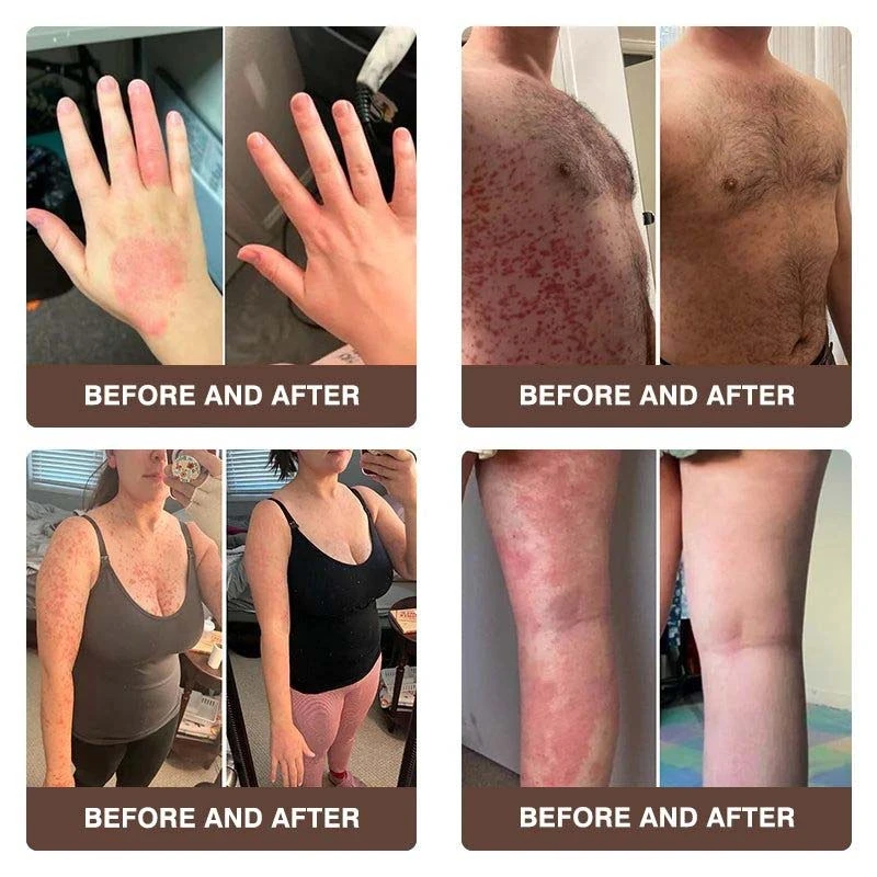 CROAIE 𝐏𝐬𝐨𝐫𝐢𝐚𝐬𝐢𝐬 & 𝐄𝐜𝐳𝐞𝐦𝐚 𝐑𝐞𝐥𝐢𝐞𝐟 𝐂𝐫𝐞𝐚𝐦 - Image 4