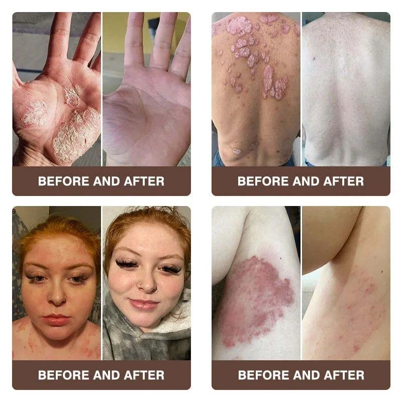 CROAIE 𝐏𝐬𝐨𝐫𝐢𝐚𝐬𝐢𝐬 & 𝐄𝐜𝐳𝐞𝐦𝐚 𝐑𝐞𝐥𝐢𝐞𝐟 𝐂𝐫𝐞𝐚𝐦 - Image 5