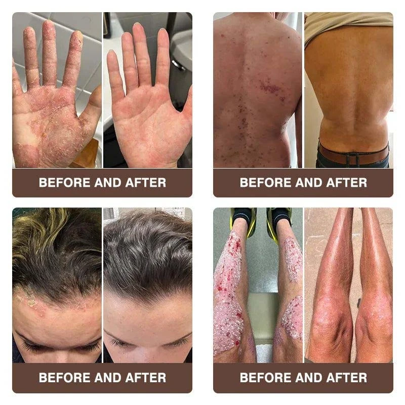 CROAIE 𝐏𝐬𝐨𝐫𝐢𝐚𝐬𝐢𝐬 & 𝐄𝐜𝐳𝐞𝐦𝐚 𝐑𝐞𝐥𝐢𝐞𝐟 𝐂𝐫𝐞𝐚𝐦 - Image 6