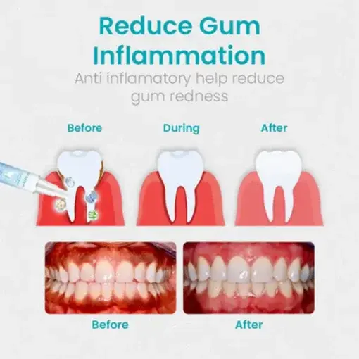 Gum Shield Therapy Gel - Image 7