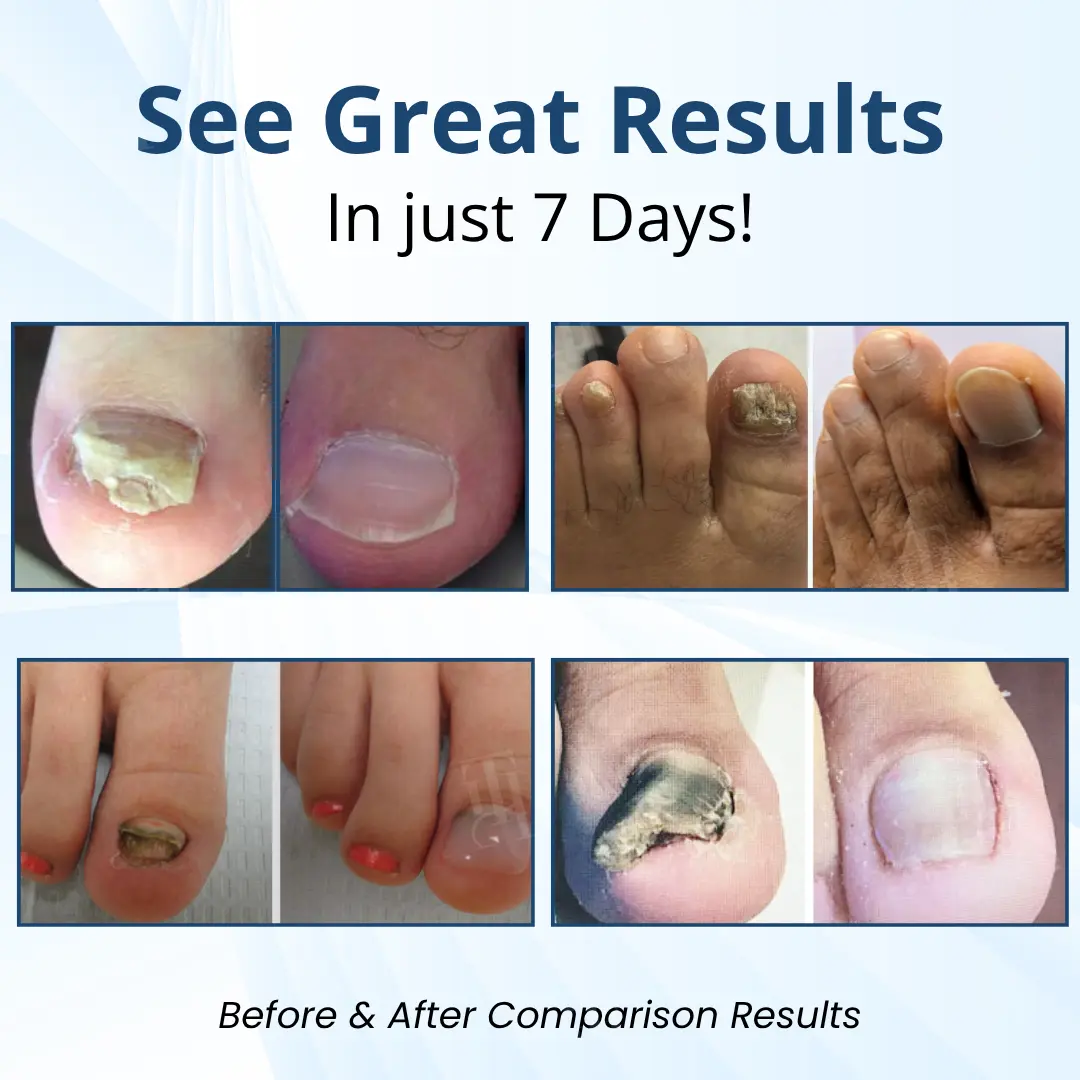 MycoShield Pro Fungal Nail Patches - Image 2