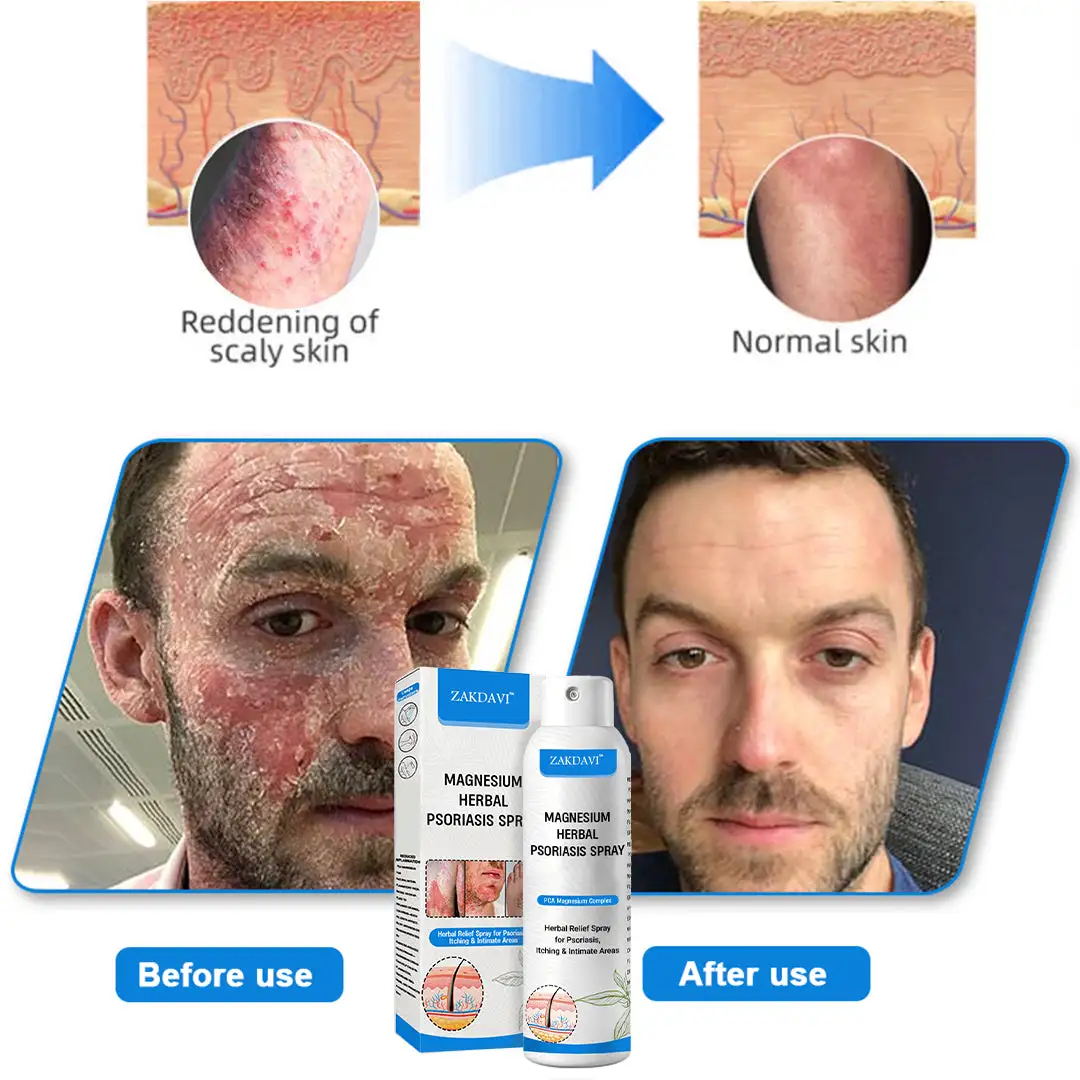 Magnesium Herbal Psoriasis Spray - Image 9