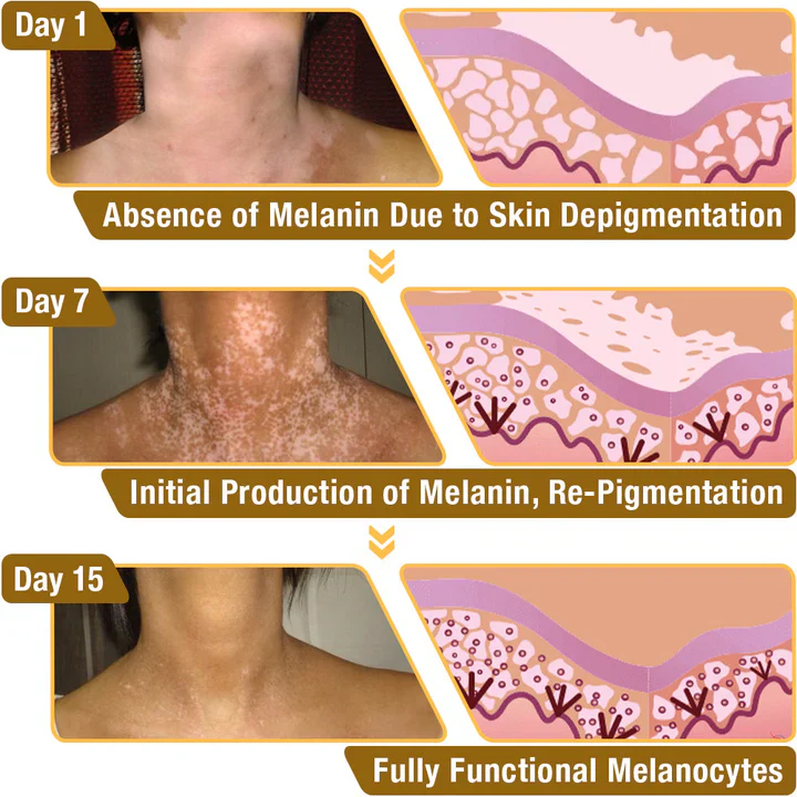BeeVenom Vitiligo Treatment Cream - Image 3