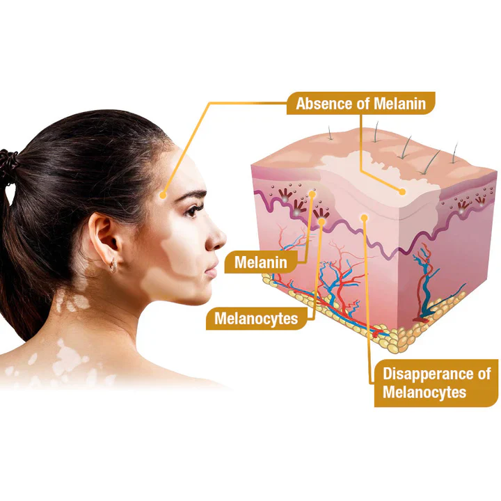 BeeVenom Vitiligo Treatment Cream - Image 5