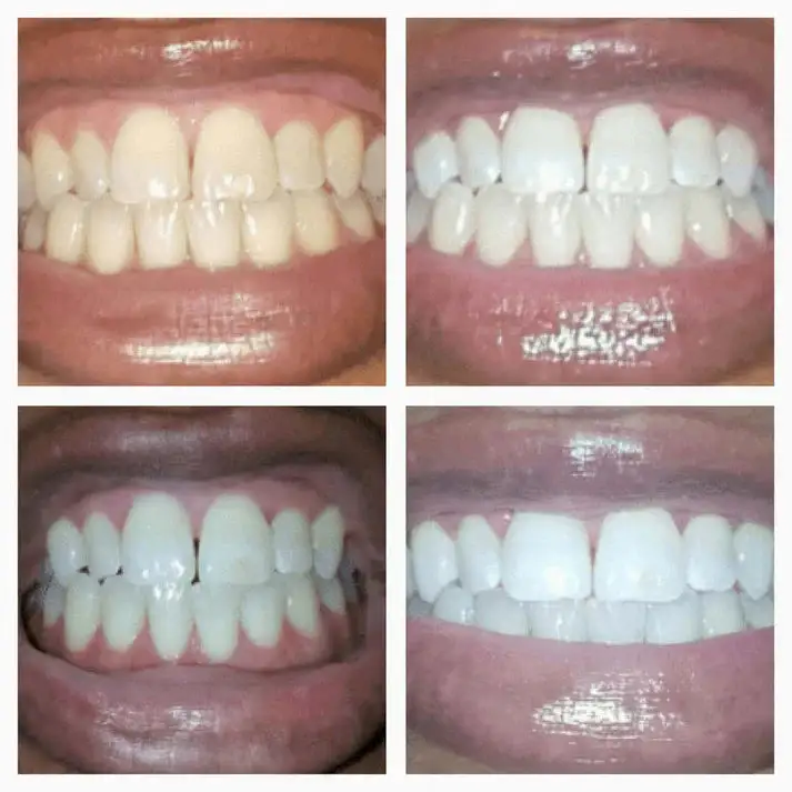 Teeth Whitening Pen - Image 6