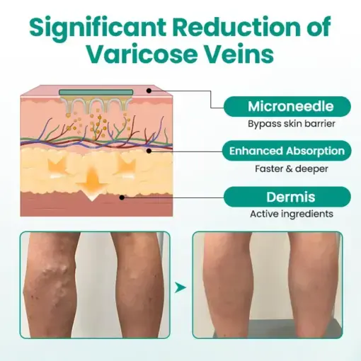 LegRenew Varicose Veins Patch - Image 2