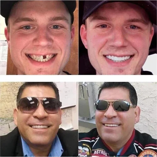 Adjustable Snap-On Dentures - Image 6