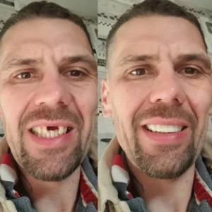 Alternative view of Advanced Custom-Fit Functional Dentures