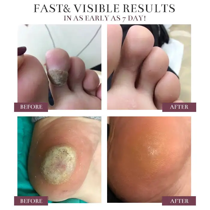 BlackRice Wart Repair Cream - Image 5