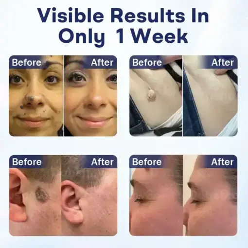 Mole and Wart Removal Cream - Image 2