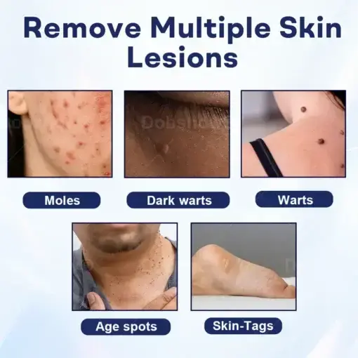 Mole and Wart Removal Cream - Image 3