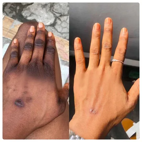 EELHOE-Acanthosis Nigricans Therapy Cream - Image 6