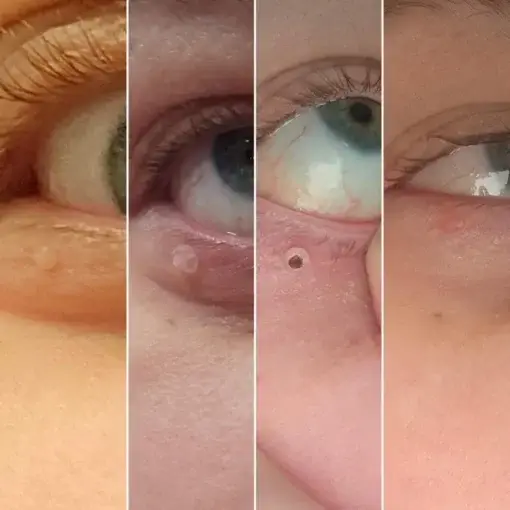 Skin Wart & Skin Tag Removal Kit - Image 2