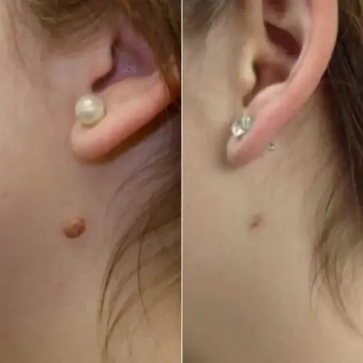 Skin Wart & Skin Tag Removal Kit - Image 3