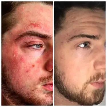 Bee Venom Eczema Treatment Cream - Image 7