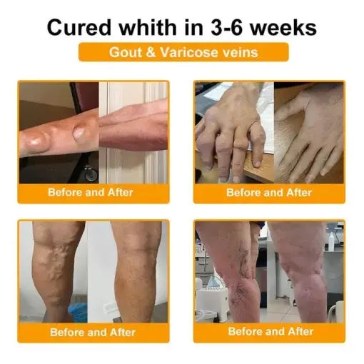 BEE VENOM LITHOSPERMUM Pain-Relief Bone Healing Cream - Image 6