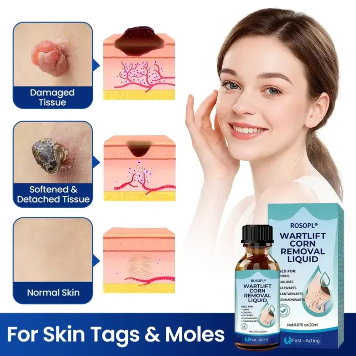 Wart Lift Wart Removal Liquid - Image 4