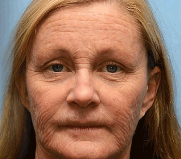 Botox & Vita-A Retinol Shot Wrinkle-Lift Tightening Cream - Image 14