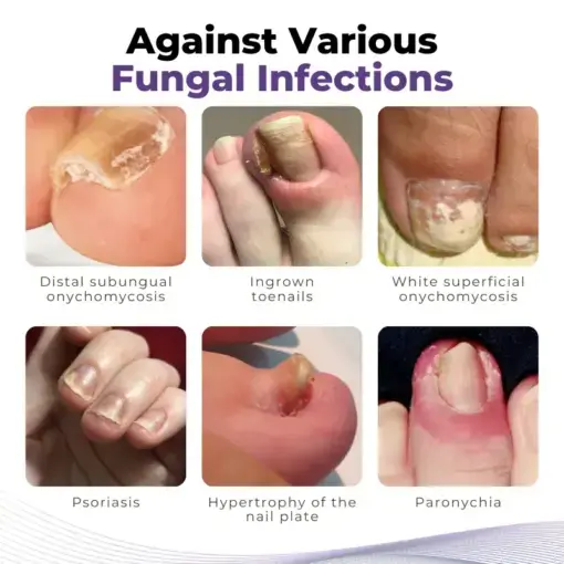 MycoOut Natural Nail Fungus Solution - Image 4