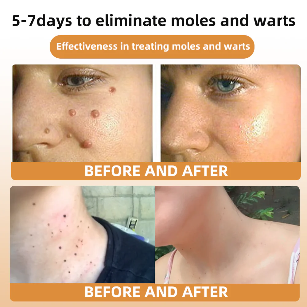 Bee Venom Wart & Tag Removal Cream - Image 5