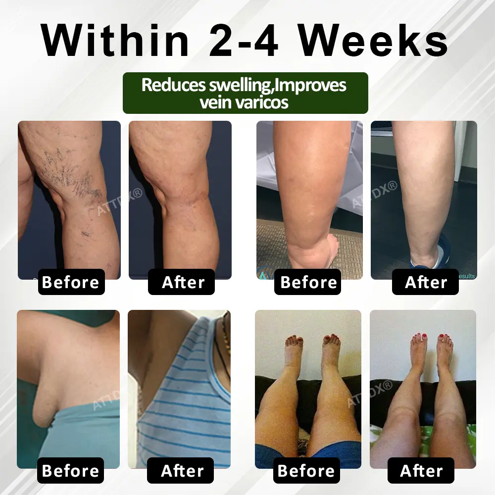 FluidEase Leg Therapy Edema Cream - Image 2