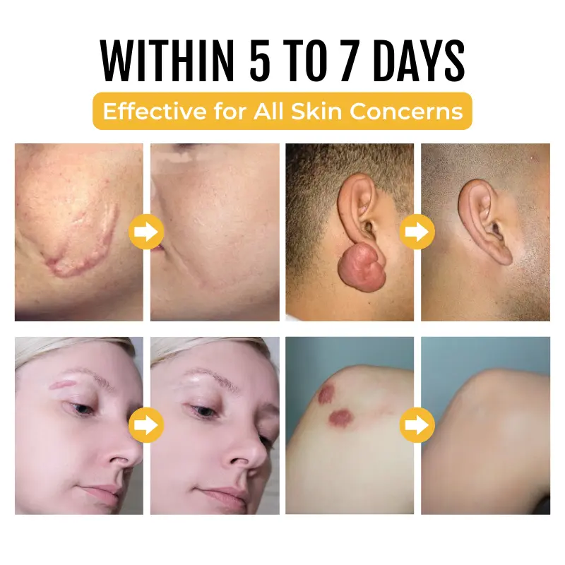 PapilloClear Bee Venom Skin Treatment Cream - Image 5