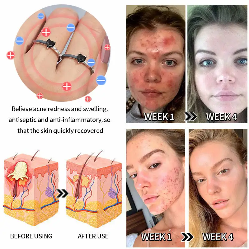 Magnetic Lymp Drainage Health Ring - Image 3