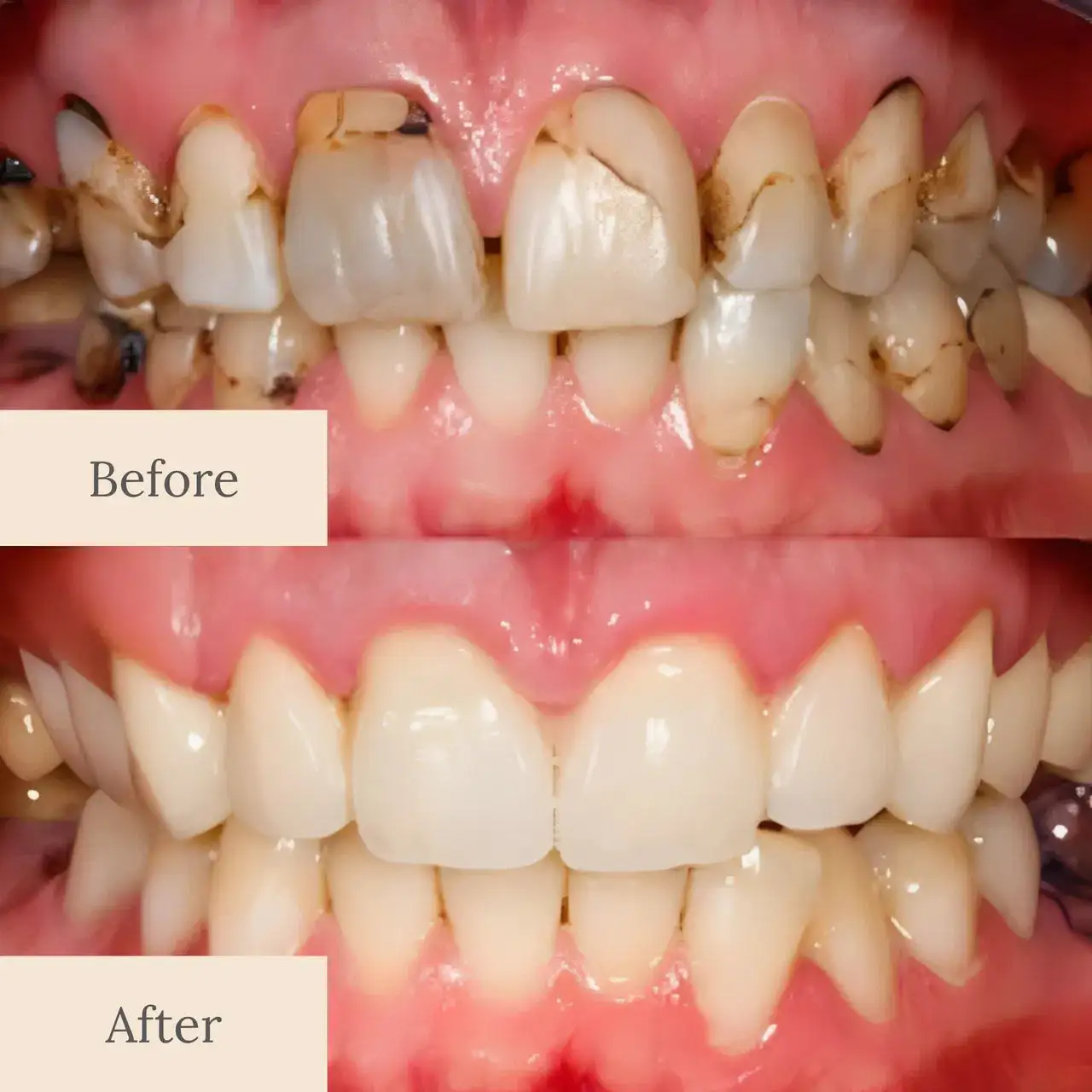 Teeth Armor Drops - Image 2