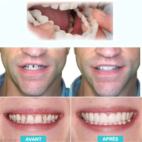 Prothèses ajustables à clipser - Image 7