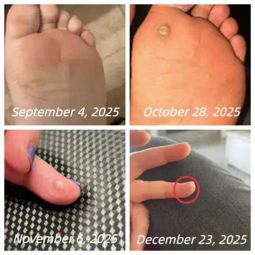 Bee Venom Spray Joint Relief Wart Treatment - Image 3