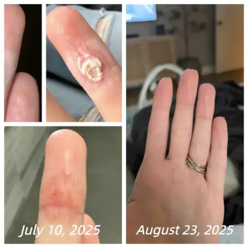 Bee Venom Spray Joint Relief Wart Treatment - Image 4