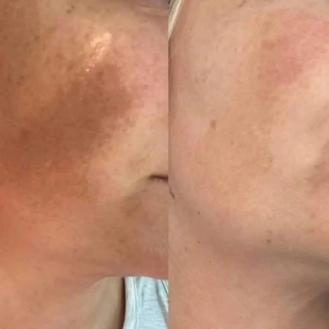 Facial Cream with 7% Arbutin + 4% Tranexamic Acid - Image 4