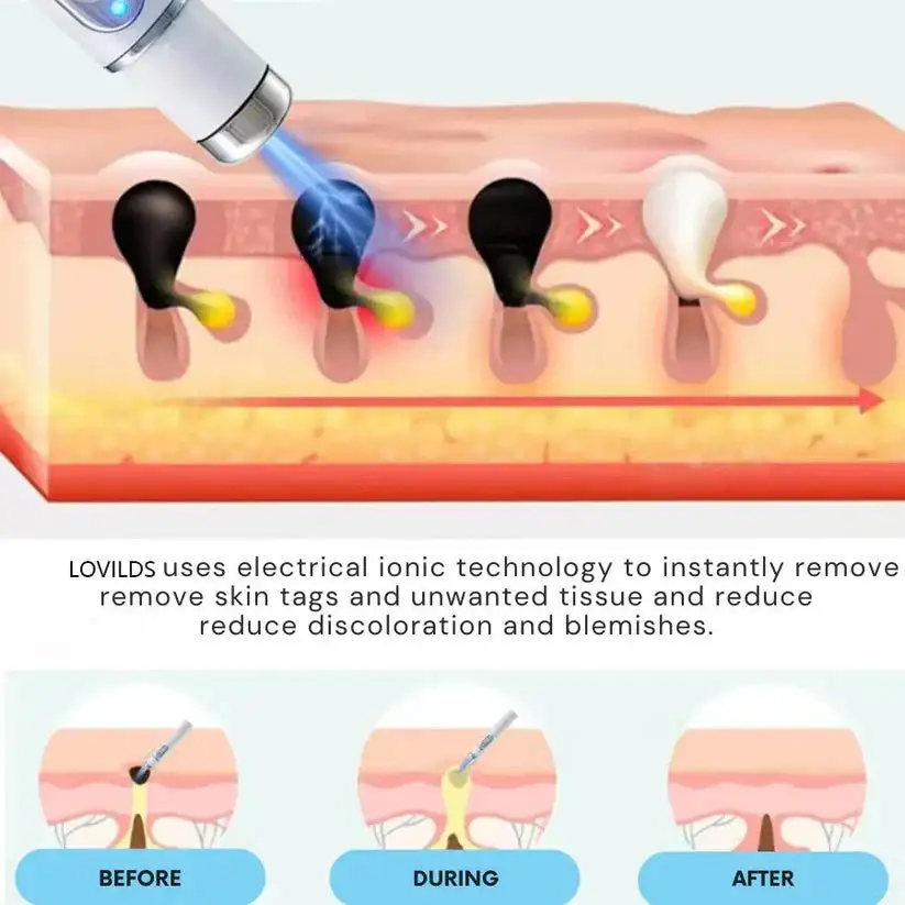 Non-Invasive Mole and Wart Removal Laser Pen - Image 3