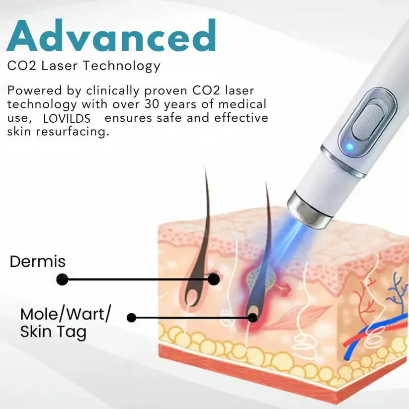 Non-Invasive Mole and Wart Removal Laser Pen - Image 5