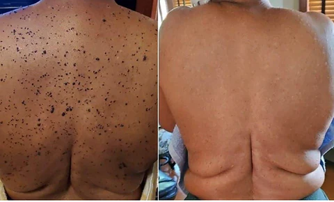 Bee Venom Mole and Wart Treatment Cream - Image 3