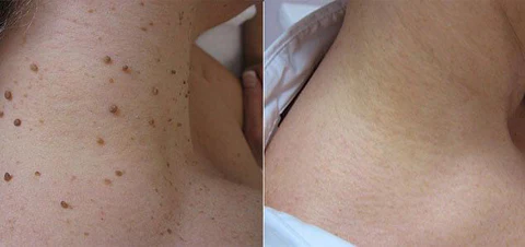 Bee Venom Mole and Wart Treatment Cream - Image 2