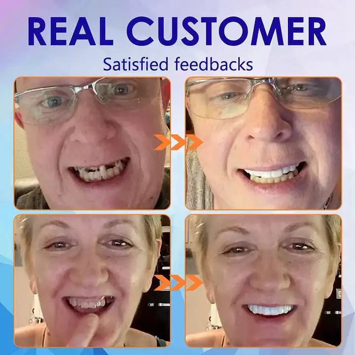 Advanced Customized Full Denture Set - Image 4