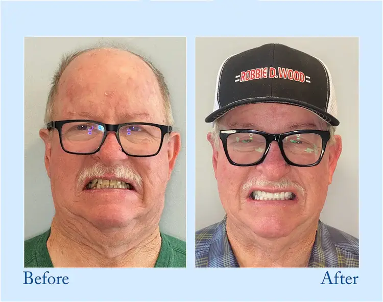 Custom-Fit Functional Dentures - Image 10