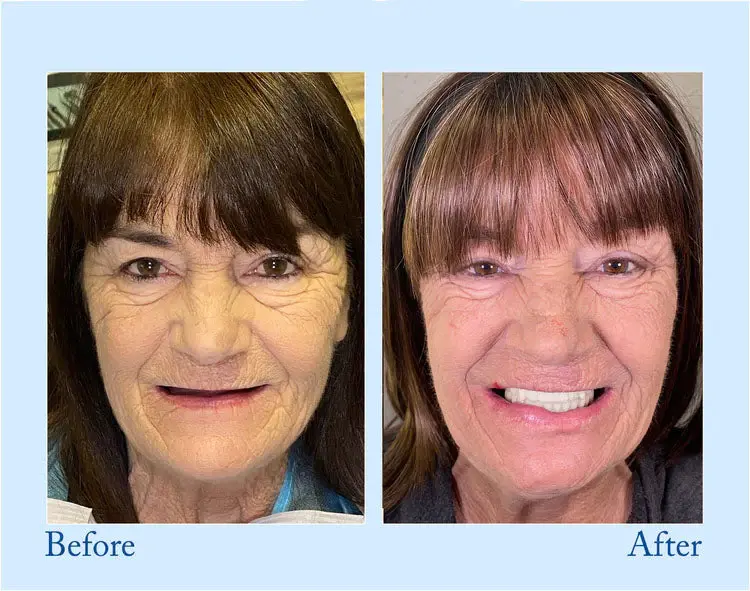 Custom-Fit Functional Dentures - Perfectly Fitted in Minutes at Home - Image 9