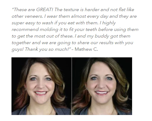 Adjustable Snap-On Dentures - Image 5