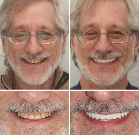 Custom-Fit Functional Denture - Image 2